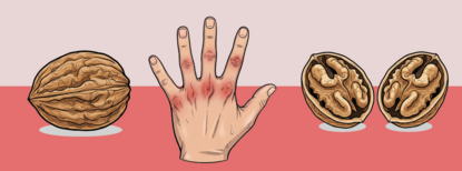 Nussknacken bei Schmerz & Kraftlosigkeit